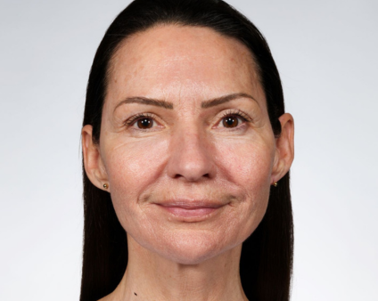 AFTER USING FUTURE RENEW SERUM FOR 12 WEEKS
