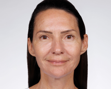 AFTER USING FUTURE RENEW SERUM FOR 12 MONTHS